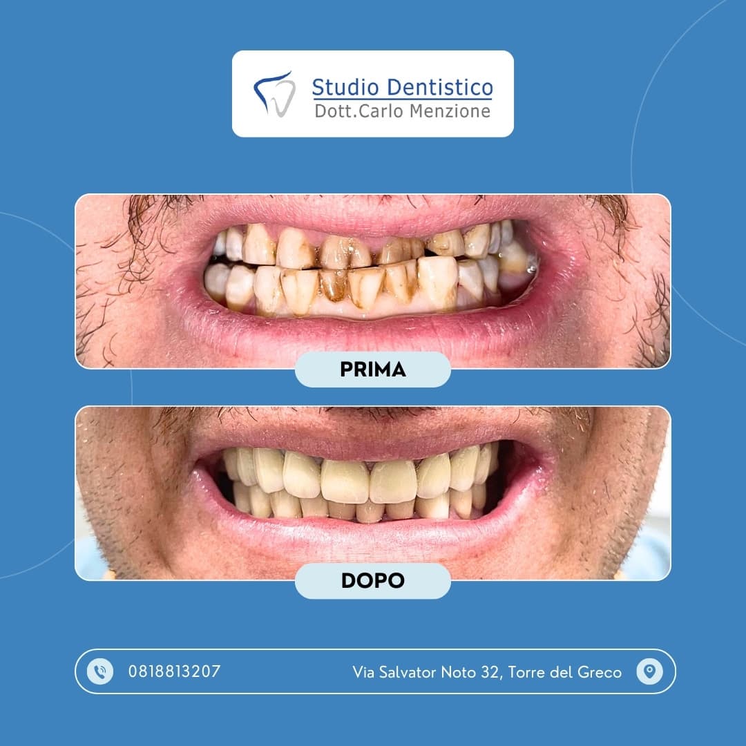 Lavoro odontoiatrico 1 — Studio Dentistico Carlo Menzione, Torre del Greco
