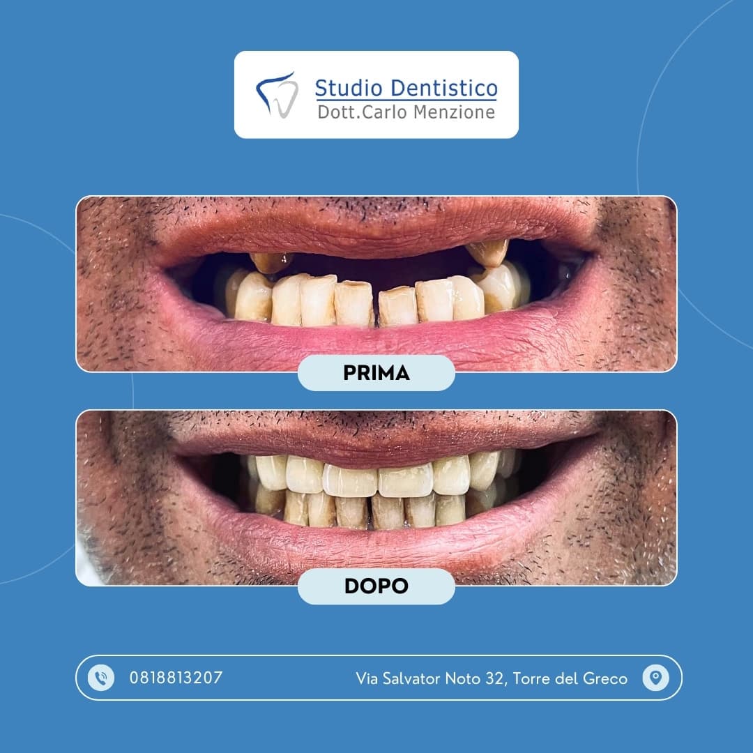 Lavoro odontoiatrico 10 — Studio Dentistico Carlo Menzione, Torre del Greco