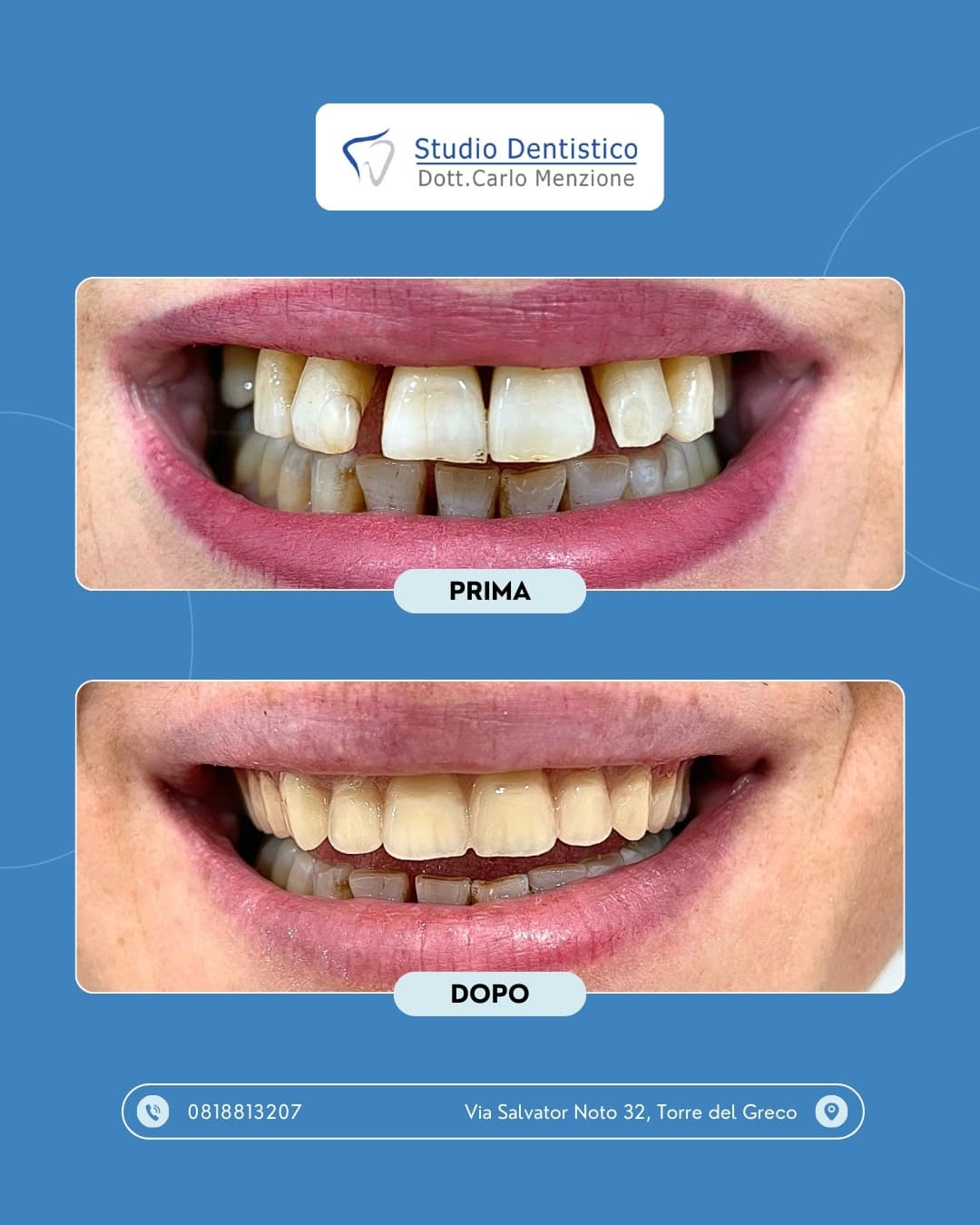 Lavoro odontoiatrico 13 — Studio Dentistico Carlo Menzione, Torre del Greco