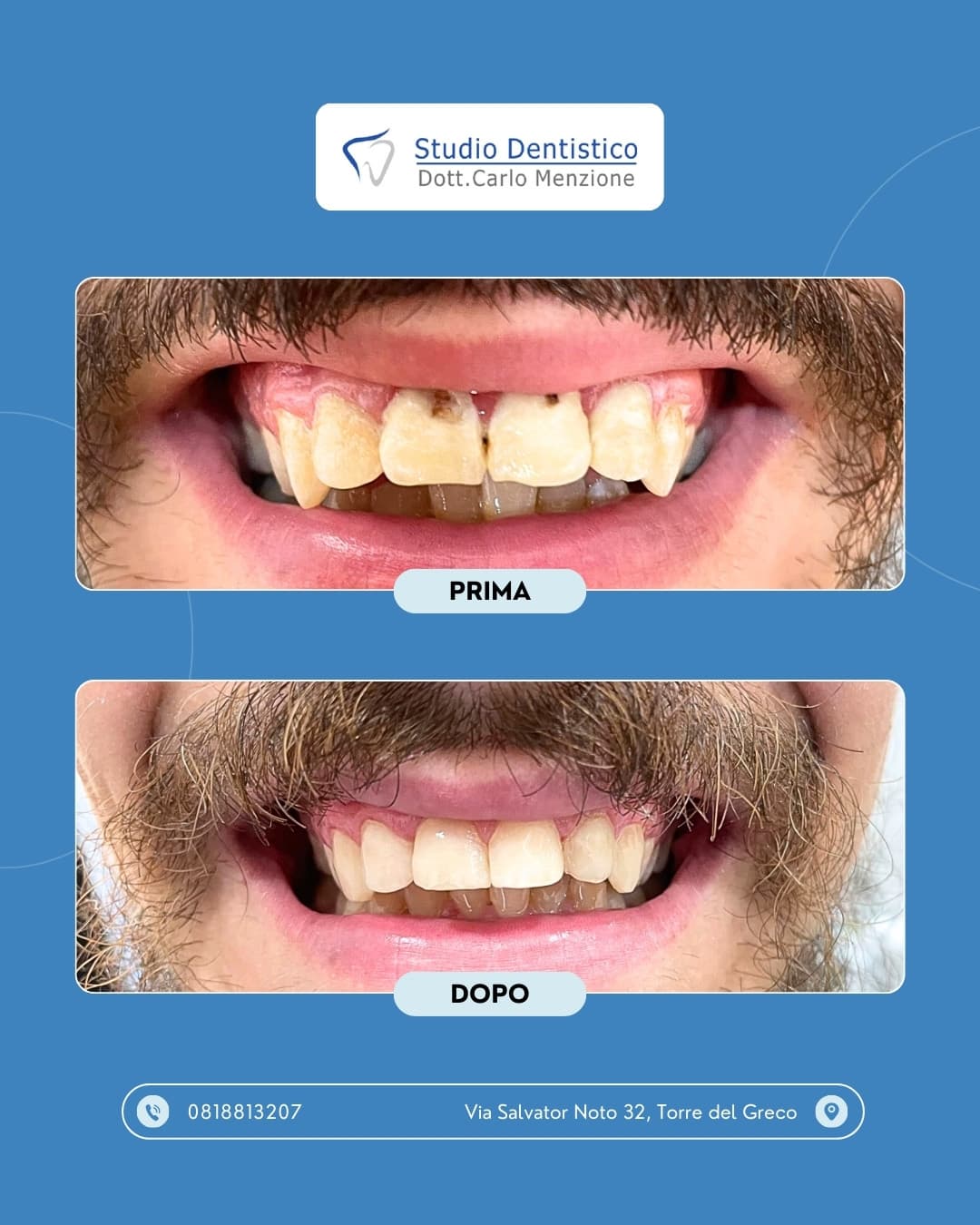 Lavoro odontoiatrico 14 — Studio Dentistico Carlo Menzione, Torre del Greco