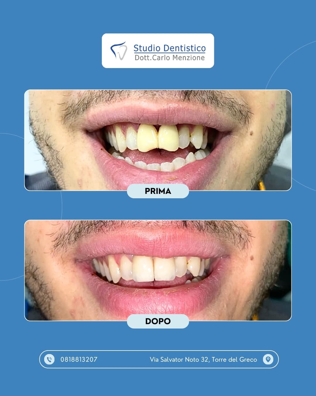 Lavoro odontoiatrico 15 — Studio Dentistico Carlo Menzione, Torre del Greco